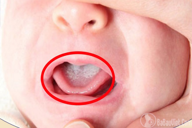 Bệnh tưa lưỡi thường gặp ở các trẻ mới sinh